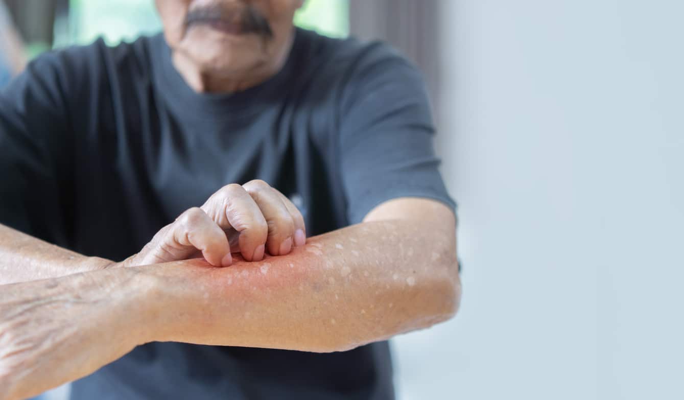 Senior man scratching his red rash