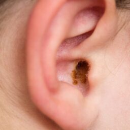 Close up of ear with healthy earwax