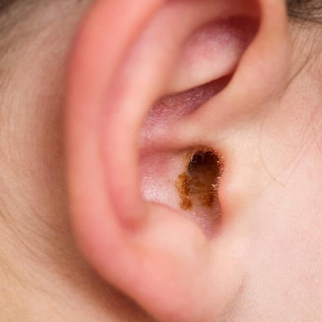 Close up of ear with earwax Close up of ear with healthy earwax
